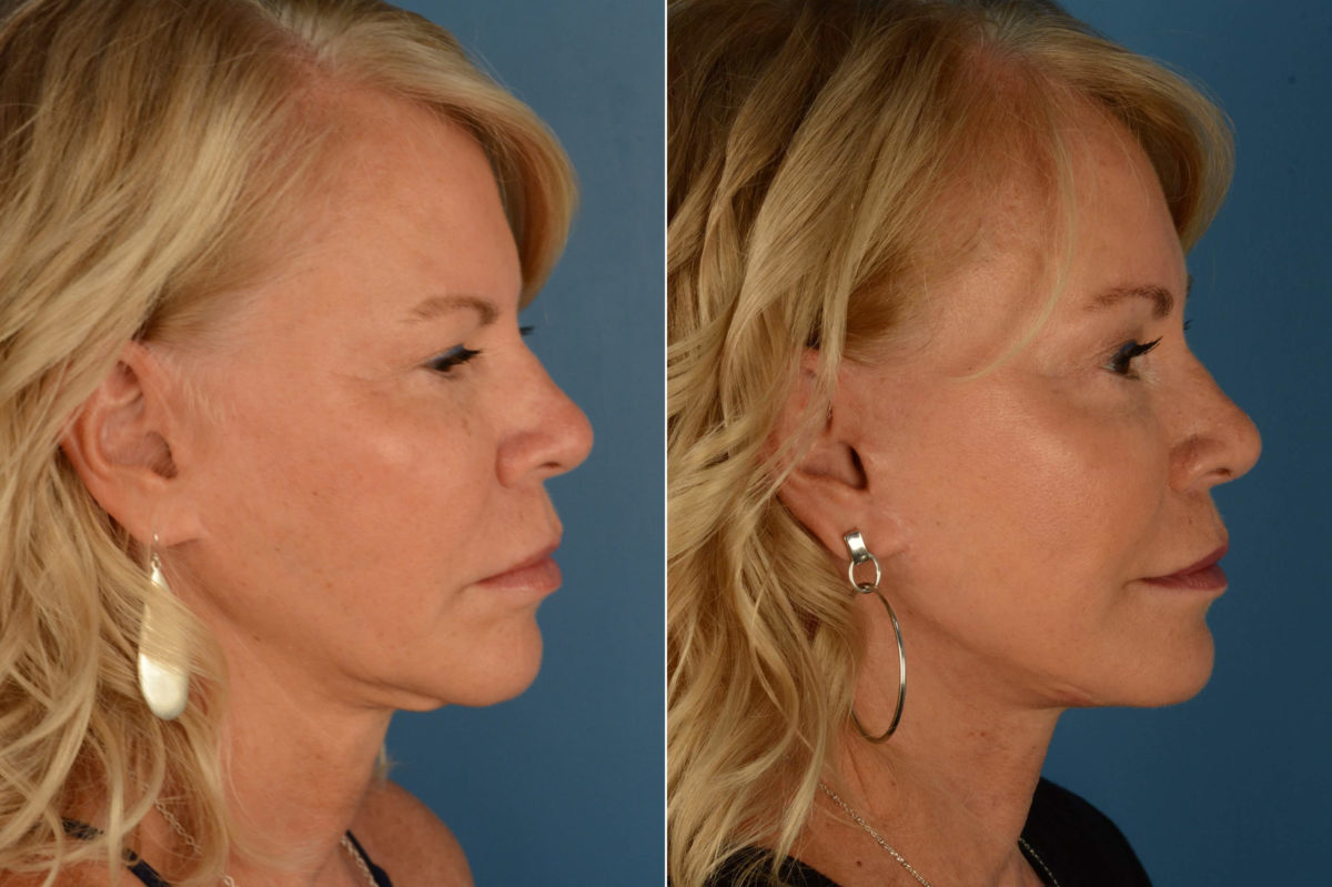 The UpLift™ Lower Face and Neck Lift Before and After Photos in Naples, FL, Patient 21847