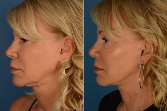 The UpLift™ Lower Face and Neck Lift Before and After Photos in Naples, FL, Patient 21847