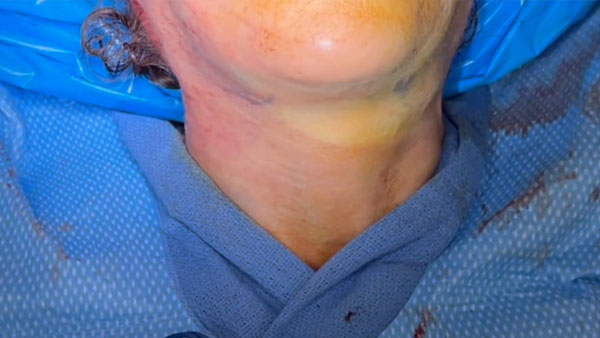 Elective Cosmetic Submandibular Gland Removal During Facelift Surgery