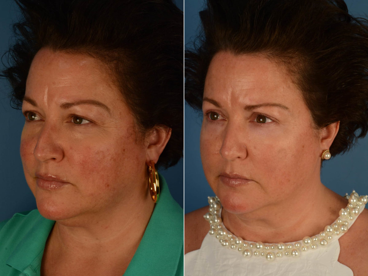 Blepharoplasty Before and After Photos in Naples, FL, Patient 21952