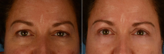 Blepharoplasty Before and After Photos in Naples, FL, Patient 21952