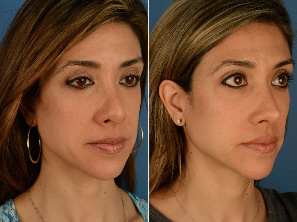 Revision Rhinoplasty Before and After Photos in Naples, FL, Patient 22031