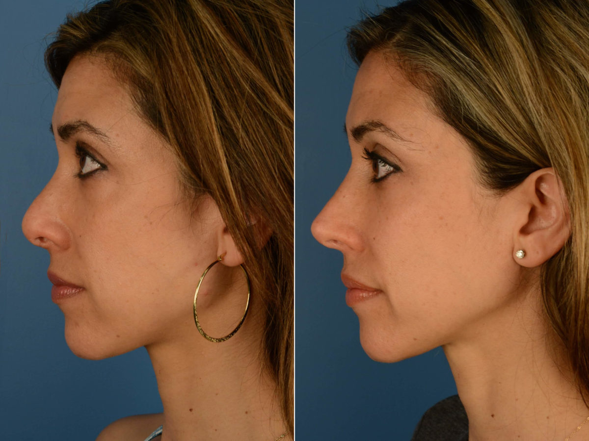 Revision Rhinoplasty Before and After Photos in Naples, FL, Patient 22031