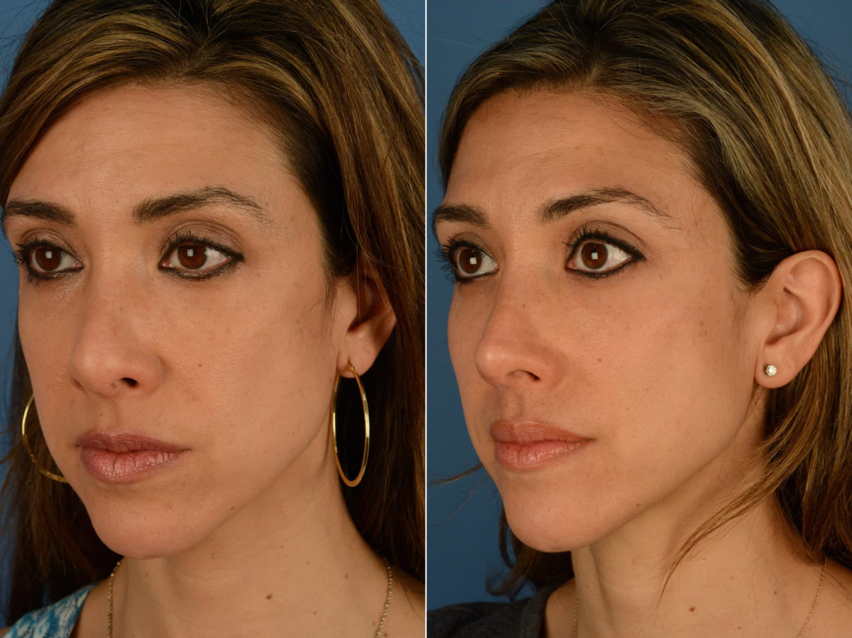 Revision Rhinoplasty Before and After Photos in Naples, FL, Patient 22031