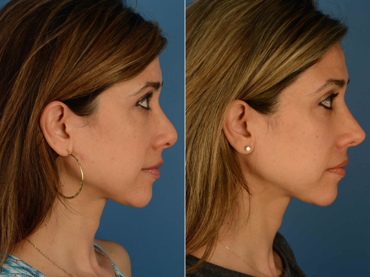 Revision Rhinoplasty Before and After Photos in Naples, FL, Patient 22031