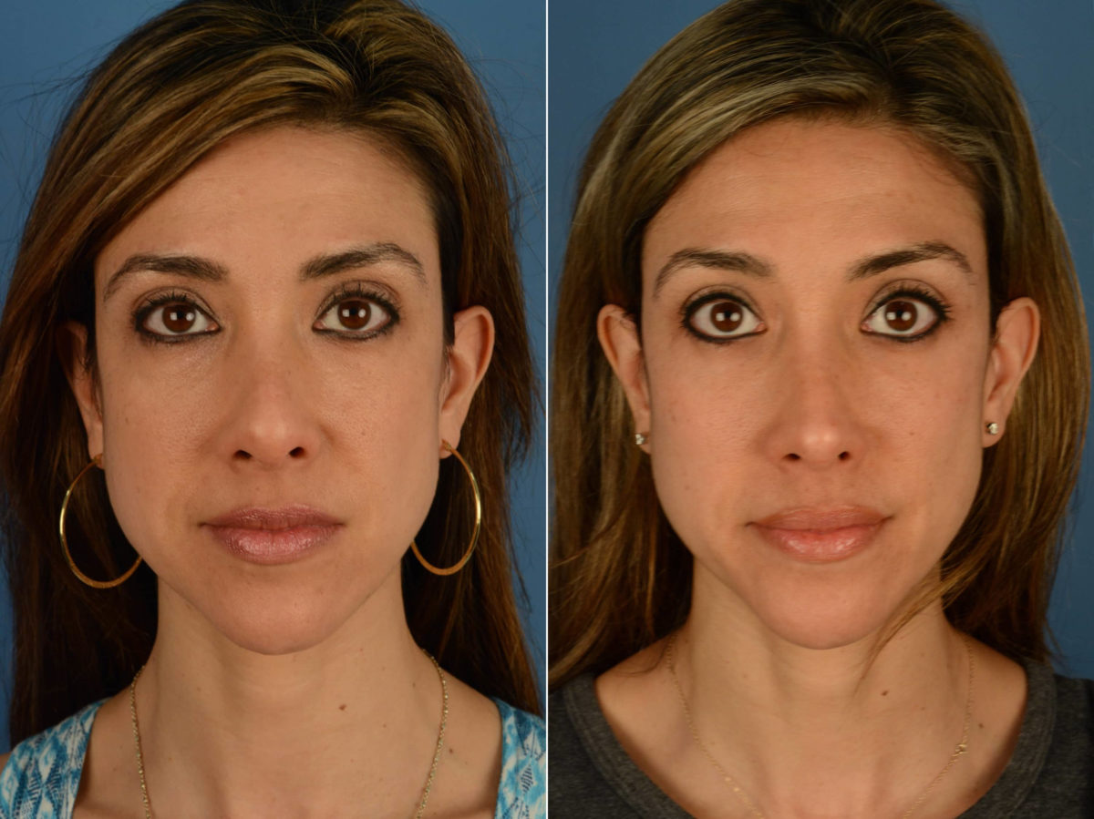 Revision Rhinoplasty Before and After Photos in Naples, FL, Patient 22031