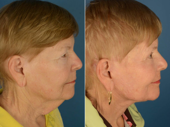 Endoscopic Facelift Before and After Photos in Naples, FL, Patient 22150
