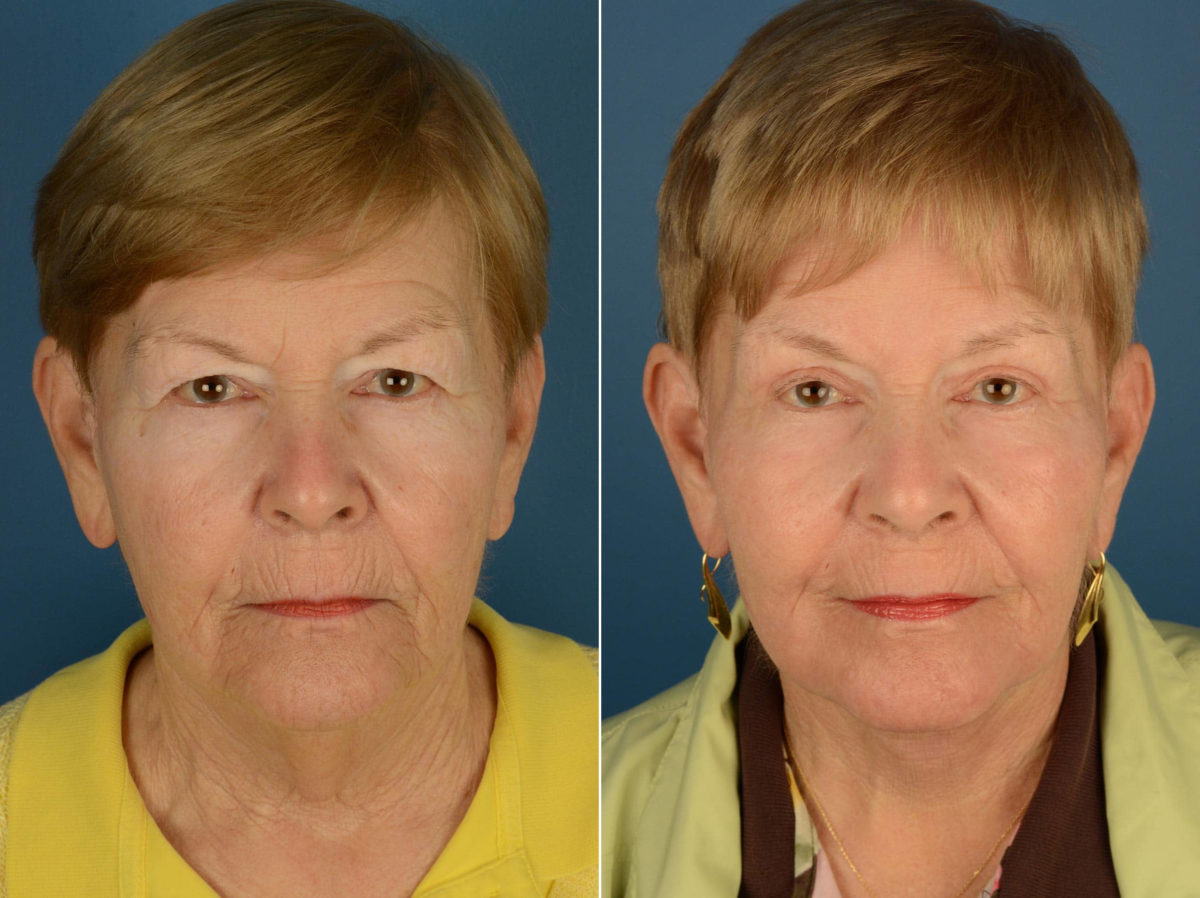 Endoscopic Facelift Before and After Photos in Naples, FL, Patient 22150