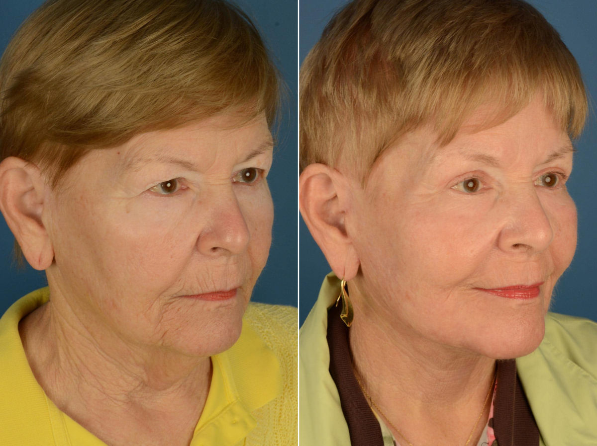 Endoscopic Facelift Before and After Photos in Naples, FL, Patient 22150