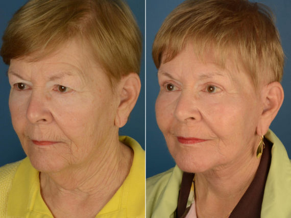Endoscopic Facelift Before and After Photos in Naples, FL, Patient 22150