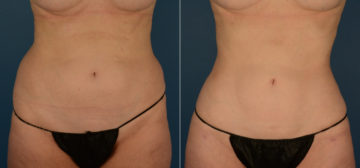 VASER® Liposuction Before and After Photos in Naples, FL, Patient 22403