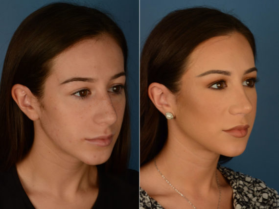 Rhinoplasty Before and After Photos in Naples, FL, Patient 22100