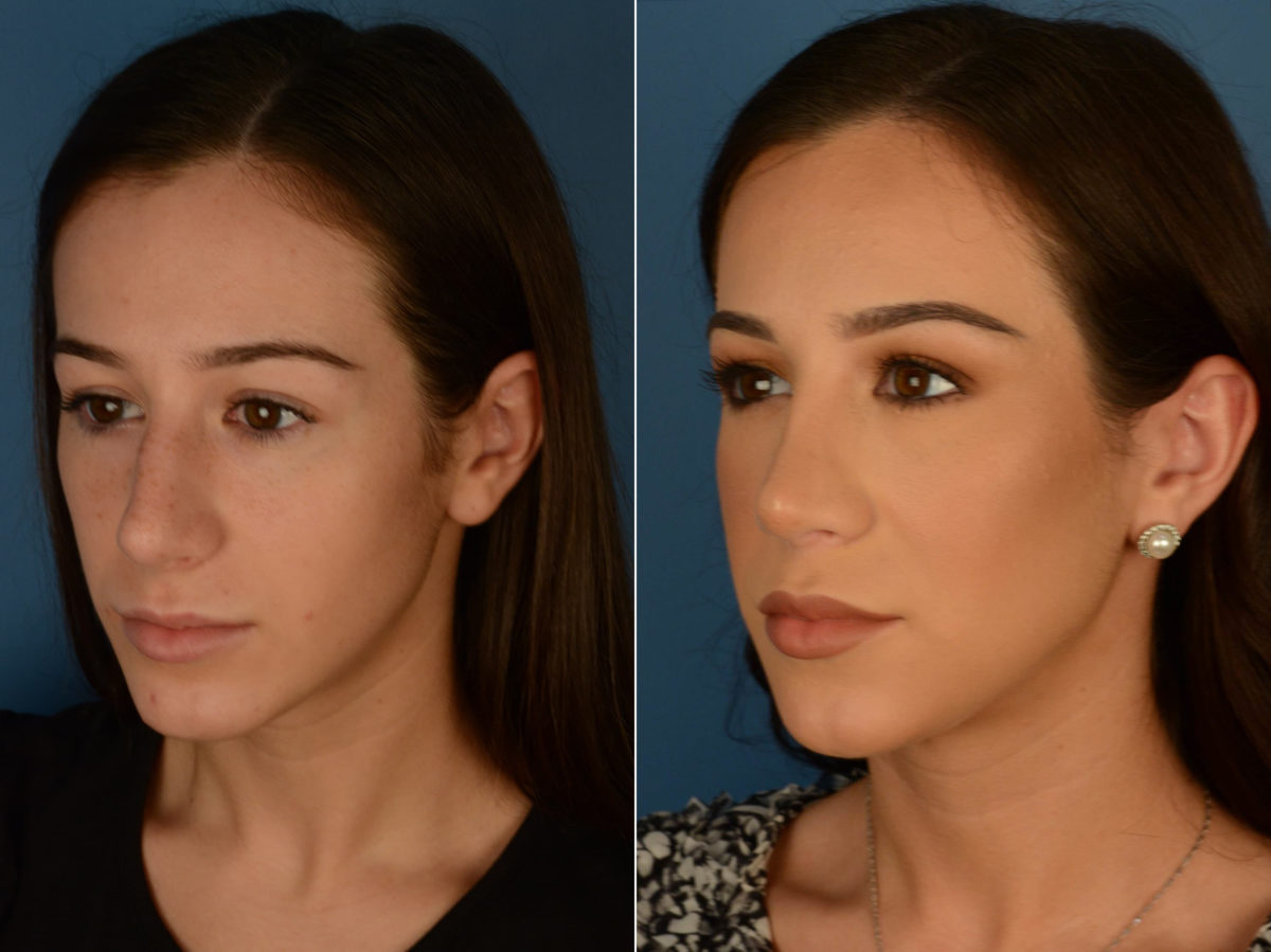 Rhinoplasty Before and After Photos in Naples, FL, Patient 22100