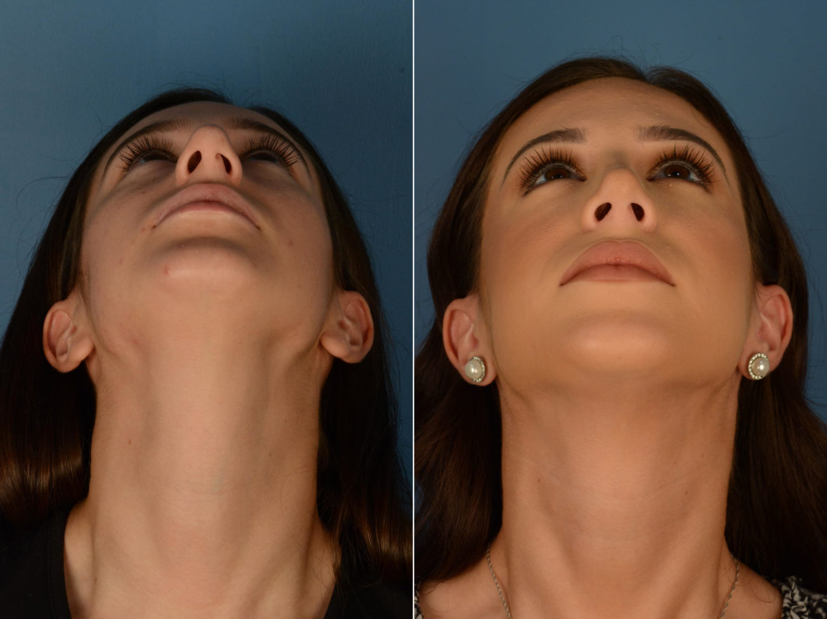 Rhinoplasty Before and After Photos in Naples, FL, Patient 22100