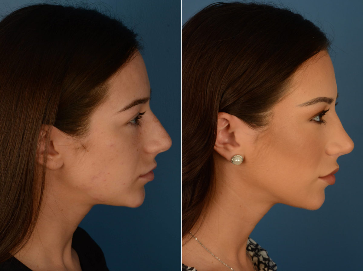 Rhinoplasty Before and After Photos in Naples, FL, Patient 22100