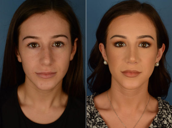 Rhinoplasty Before and After Photos in Naples, FL, Patient 22100