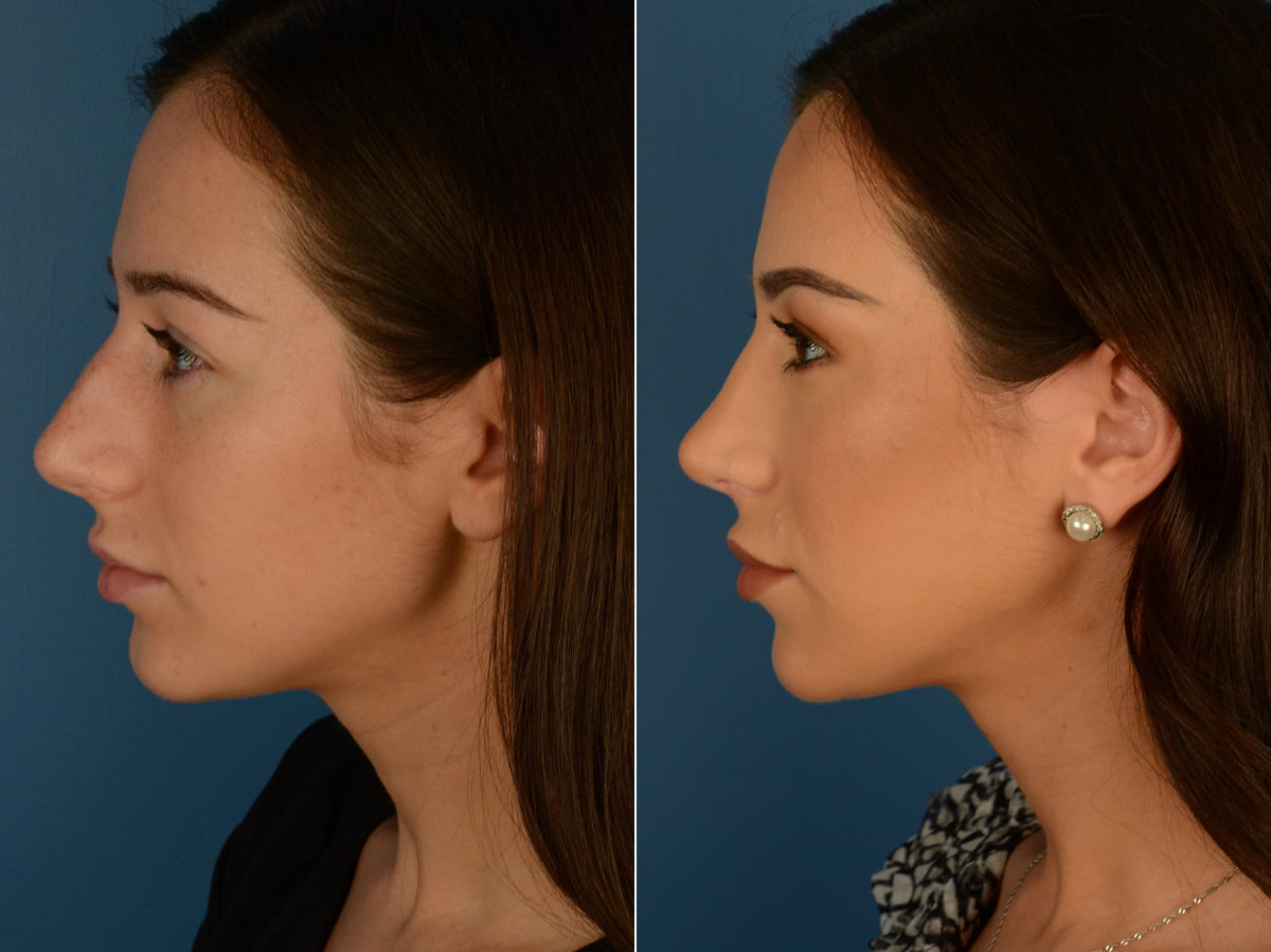 Rhinoplasty Before and After Photos in Naples, FL, Patient 22100