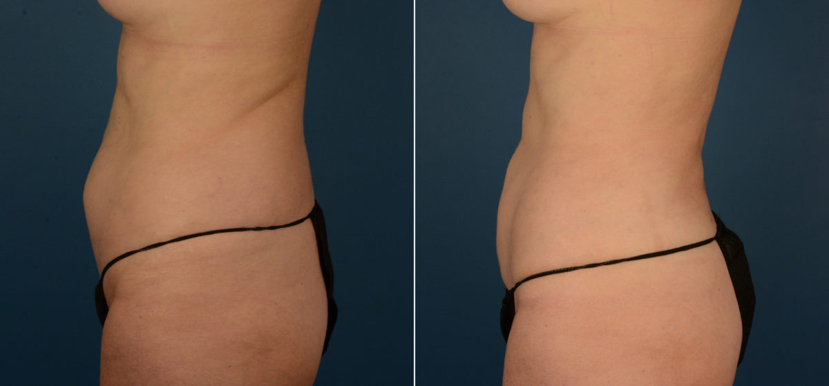 VASER® Liposuction Before and After Photos in Naples, FL, Patient 22403