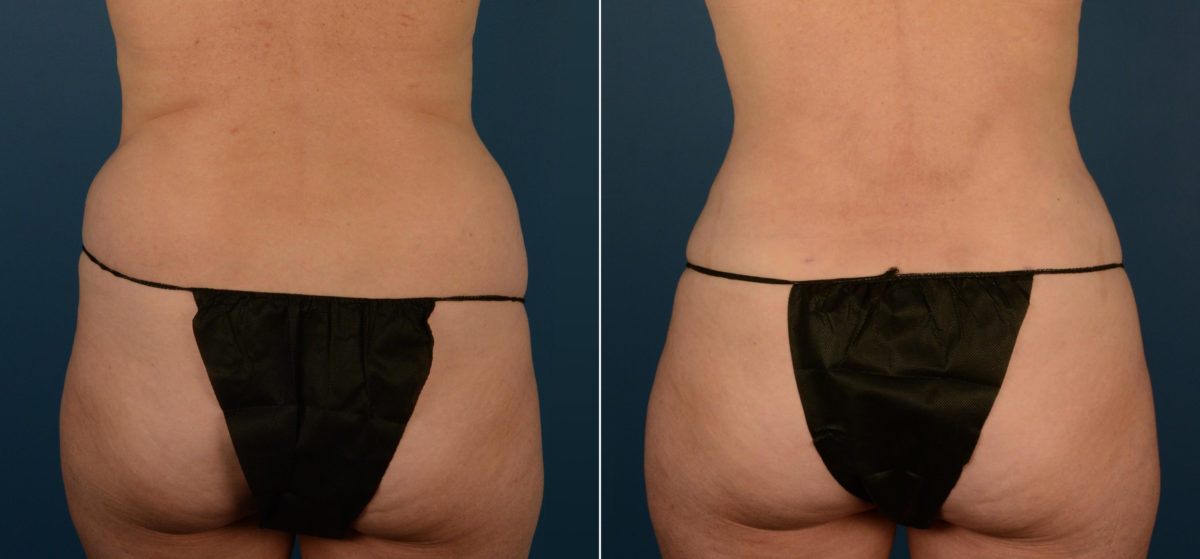 VASER® Liposuction Before and After Photos in Naples, FL, Patient 22403