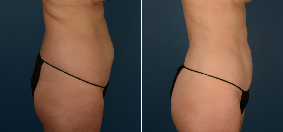 VASER® Liposuction Before and After Photos in Naples, FL, Patient 22403