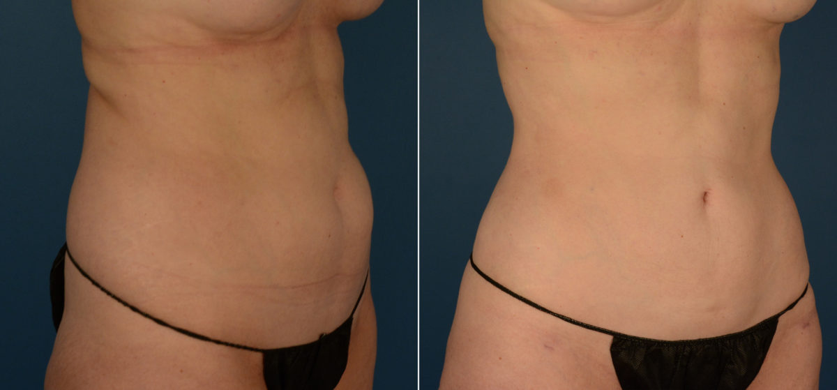 VASER® Liposuction Before and After Photos in Naples, FL, Patient 22403