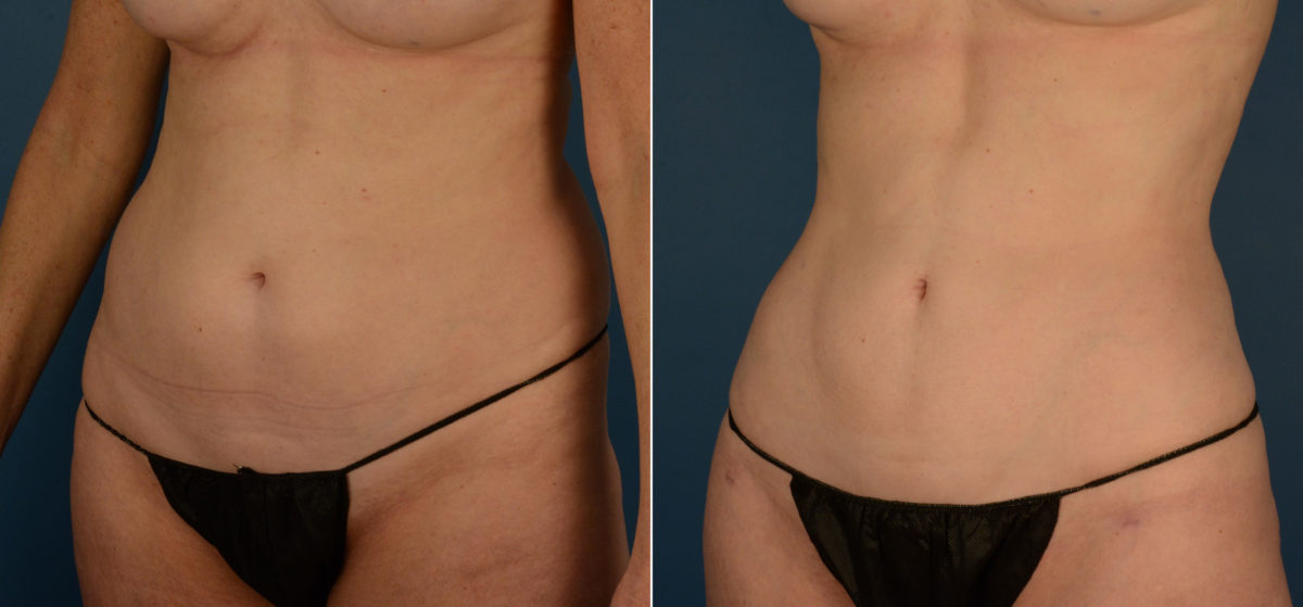 VASER® Liposuction Before and After Photos in Naples, FL, Patient 22403
