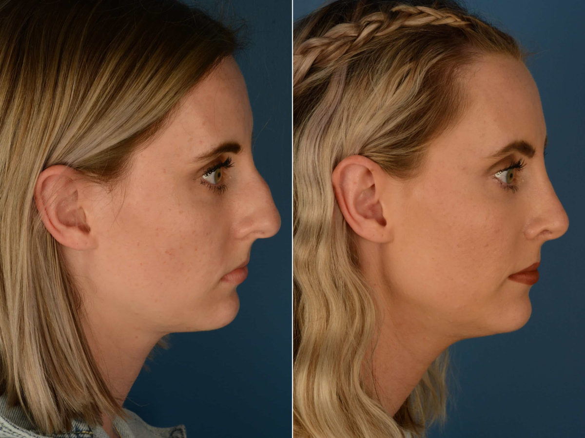 Rhinoplasty Before and After Photos in Naples, FL, Patient 22627