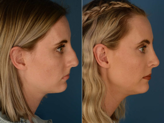 Rhinoplasty Before and After Photos in Naples, FL, Patient 22627