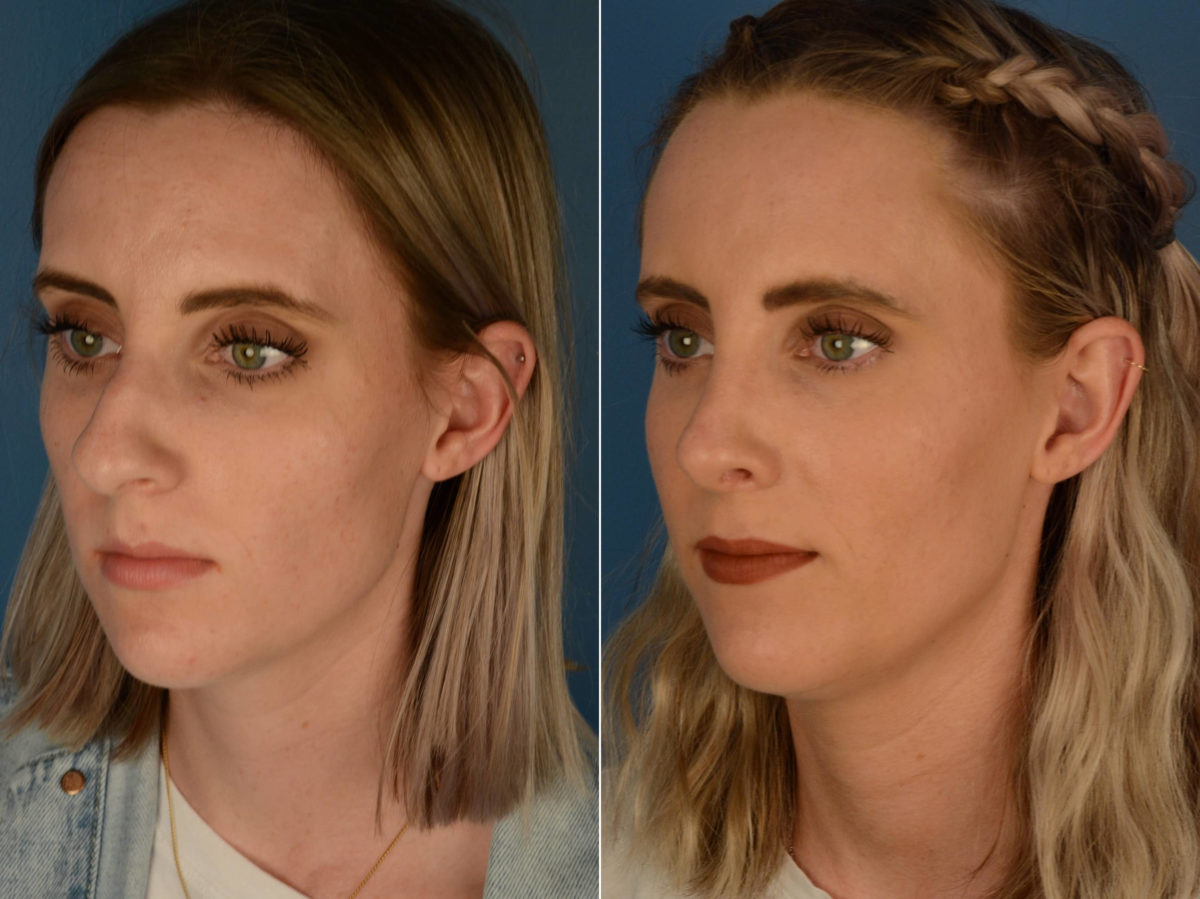 Rhinoplasty Before and After Photos in Naples, FL, Patient 22627