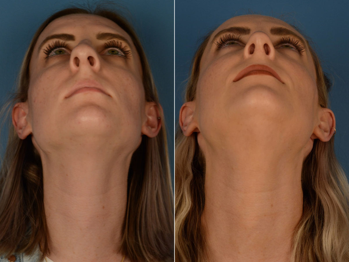 Rhinoplasty Before and After Photos in Naples, FL, Patient 22627