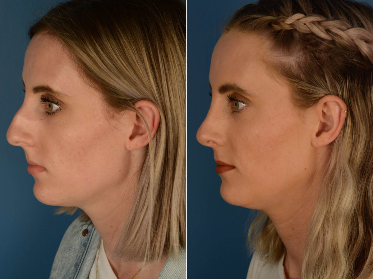 Rhinoplasty Before and After Photos in Naples, FL, Patient 22627