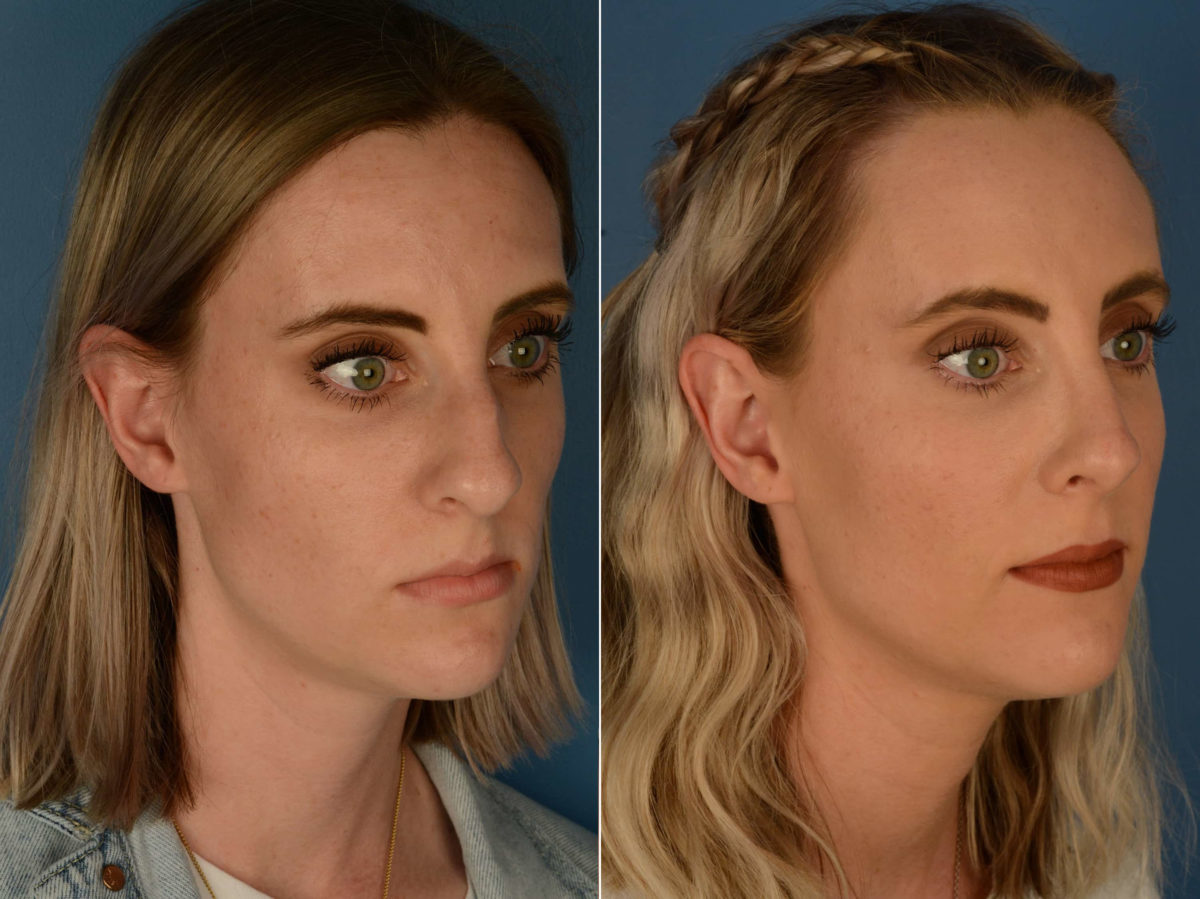 Rhinoplasty Before and After Photos in Naples, FL, Patient 22627