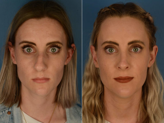 Rhinoplasty Before and After Photos in Naples, FL, Patient 22627