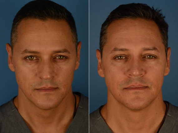 Rhinoplasty Before and After Photos in Naples, FL, Patient 22656