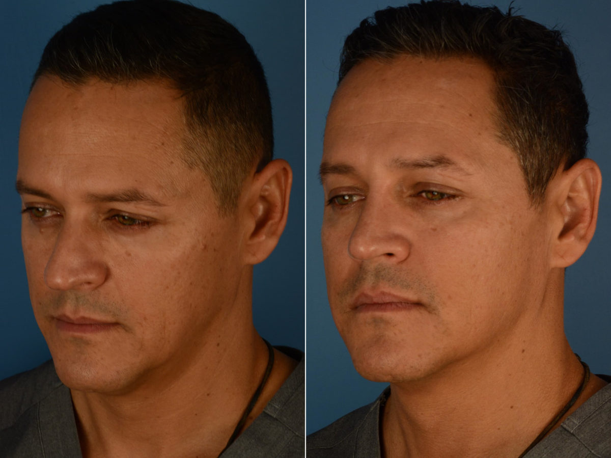 Rhinoplasty Before and After Photos in Naples, FL, Patient 22656