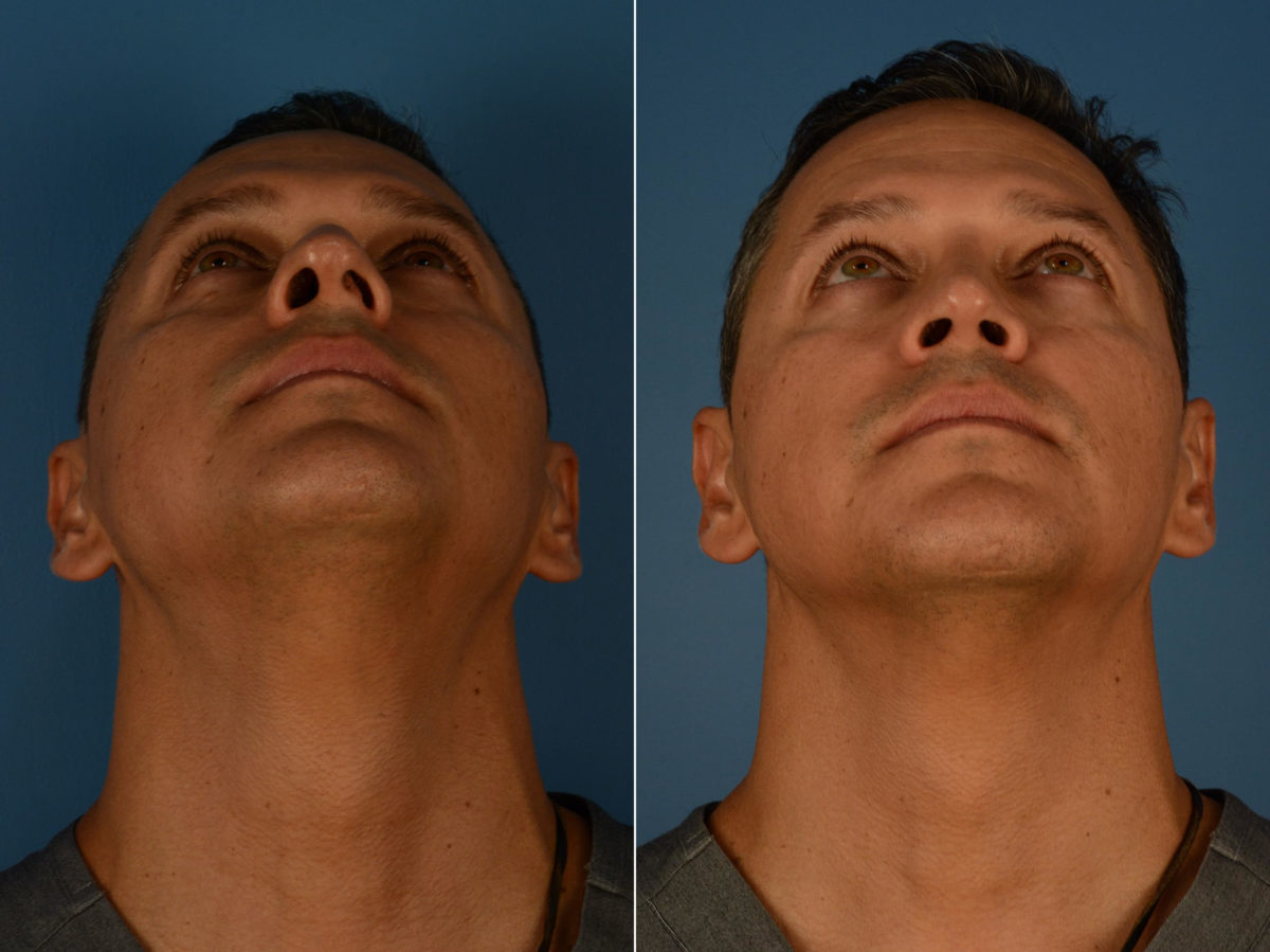 Rhinoplasty Before and After Photos in Naples, FL, Patient 22656