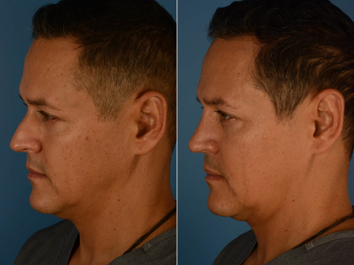 Rhinoplasty Before and After Photos in Naples, FL, Patient 22656