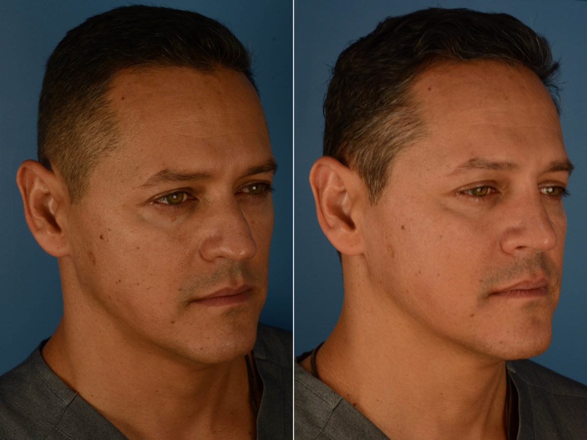 Rhinoplasty Before and After Photos in Naples, FL, Patient 22656