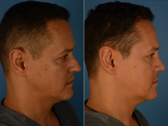 Rhinoplasty Before and After Photos in Naples, FL, Patient 22656