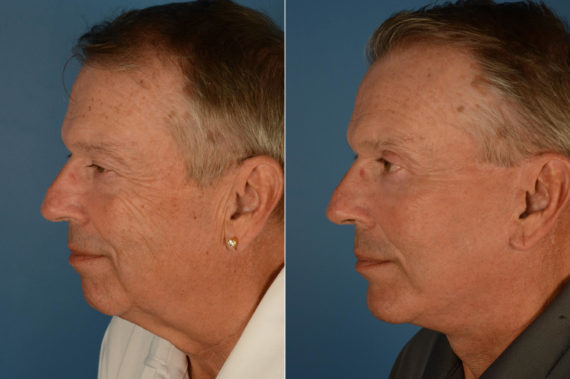 The UpLift™ Lower Face and Neck Lift Before and After Photos in Naples, FL, Patient 22675