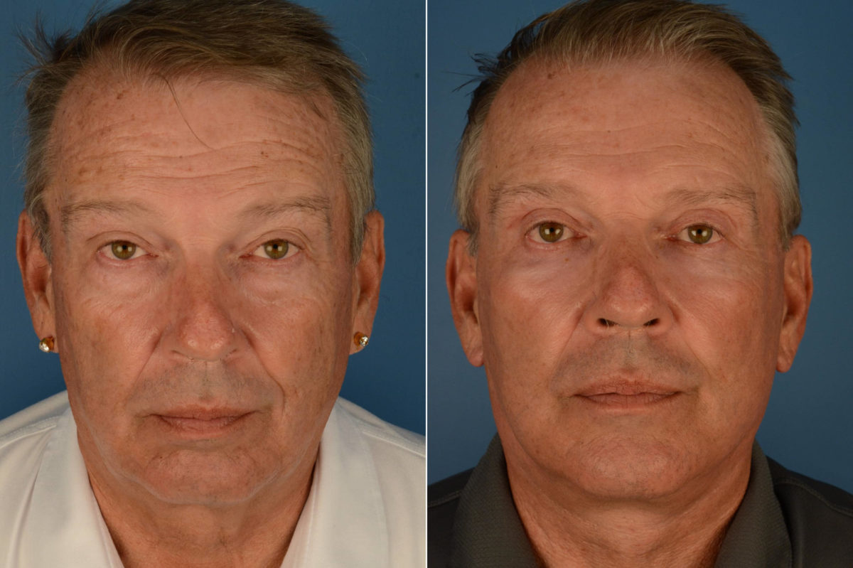 The UpLift™ Lower Face and Neck Lift Before and After Photos in Naples, FL, Patient 22675