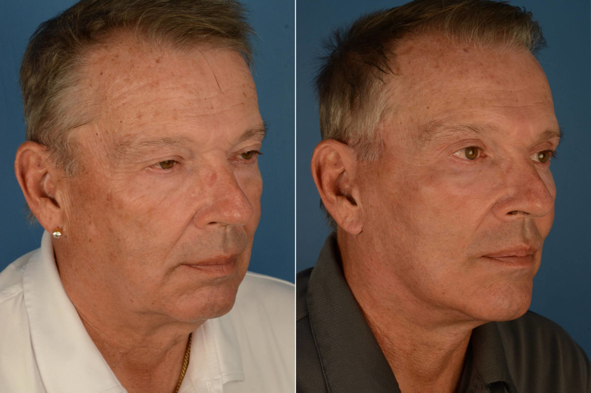 The UpLift™ Lower Face and Neck Lift Before and After Photos in Naples, FL, Patient 22675