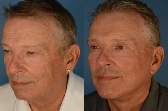 The UpLift™ Lower Face and Neck Lift Before and After Photos in Naples, FL, Patient 22675