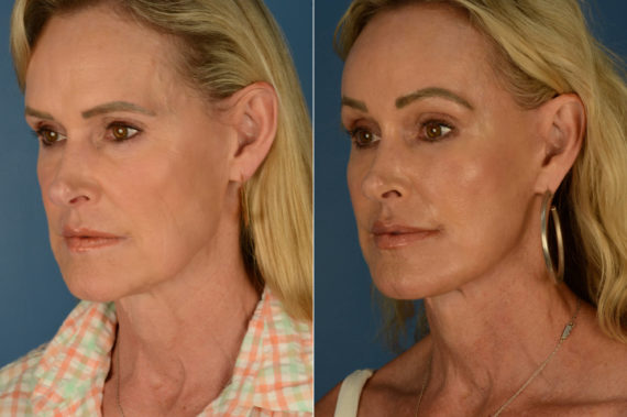 Endoscopic Facelift Before and After Photos in Naples, FL, Patient 22707