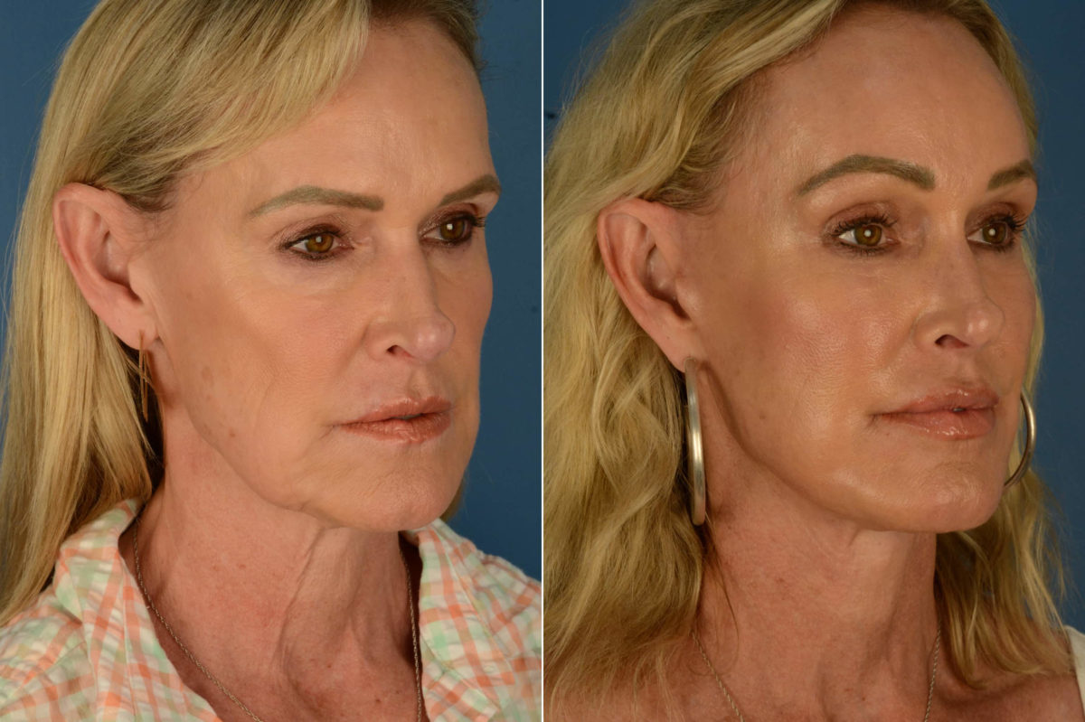 Endoscopic Facelift Before and After Photos in Naples, FL, Patient 22707