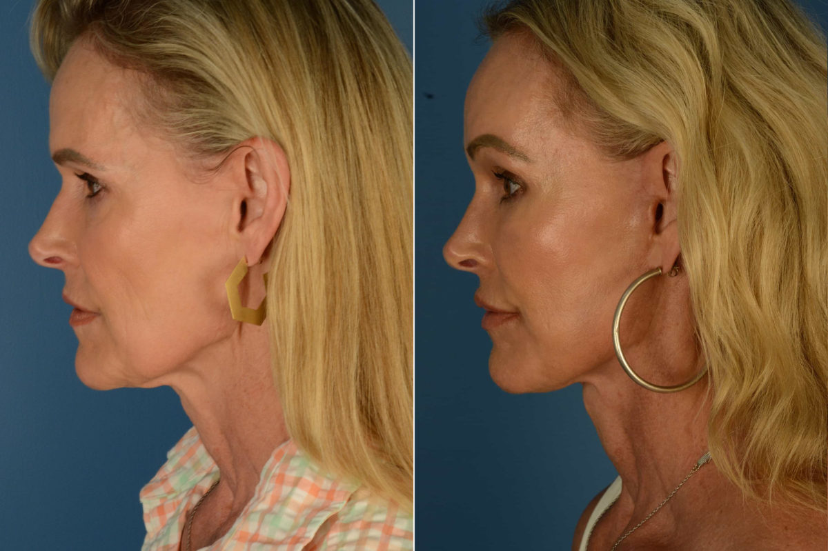 Endoscopic Facelift Before and After Photos in Naples, FL, Patient 22707
