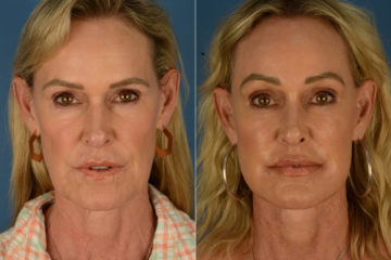 Endoscopic Facelift Before and After Photos in Naples, FL, Patient 22707