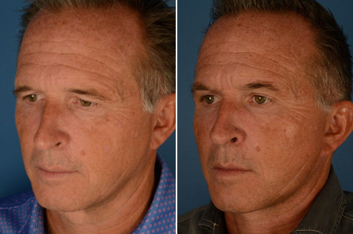 Eyebrow & Forehead Before and After Photos in Naples, FL, Patient 22888