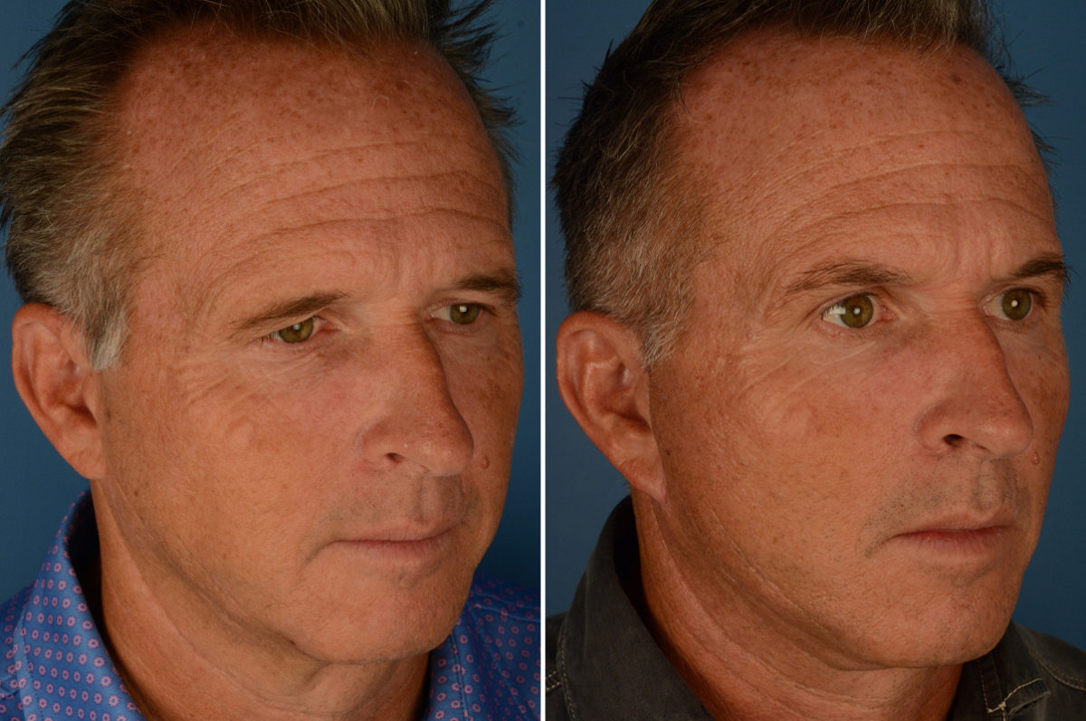 Eyebrow & Forehead Before and After Photos in Naples, FL, Patient 22888