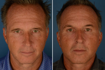 Eyebrow & Forehead Before and After Photos in Naples, FL, Patient 22888